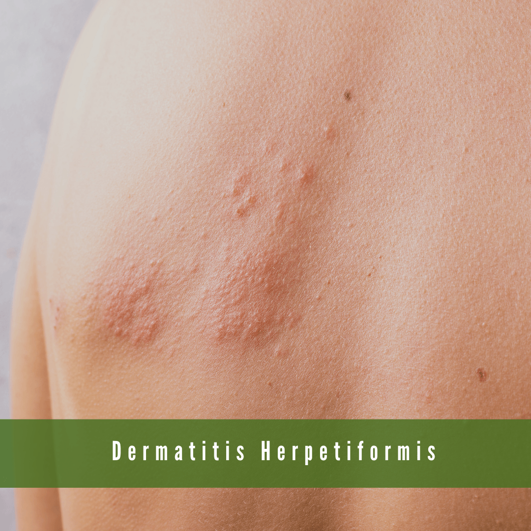 People With Dermatitis Herpetiformis (DH)